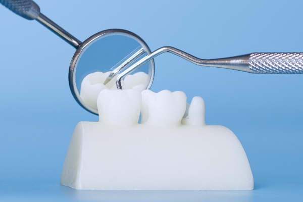 What To Expect The Day Of Dental Crown Placement